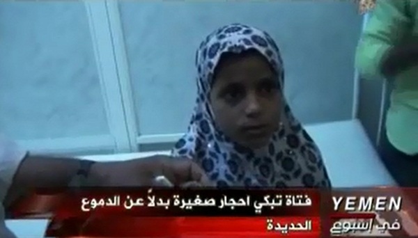 Cô bé 12 tuổi khóc ra đá ở Yemen 1