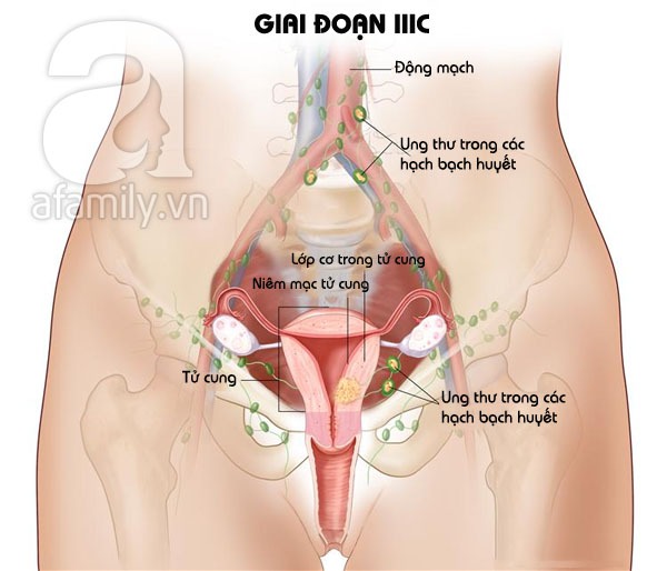 Nhin tan mat cac giai doan cua ung thu noi mac tu cung 5