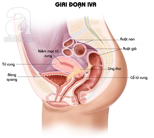 Nhìn tận mắt các giai đoạn của ung thư nội mạc tử cung 6