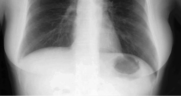 Top 5 triệu chứng dễ nhận biết của bệnh ung thư phổi 1