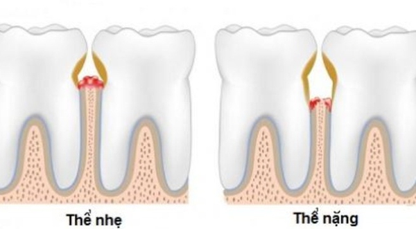 Chớ xem thường bệnh viêm lợi 1