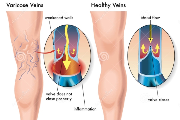 Suy giãn tĩnh mạch chân: bệnh không thể coi thường 1