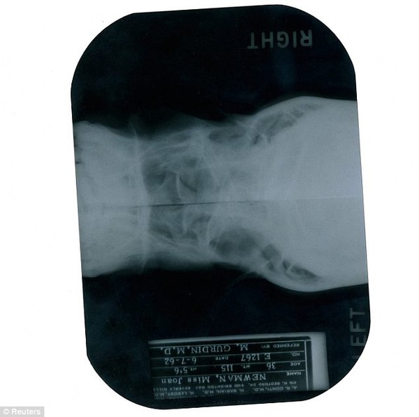 Lộ phim chụp X quang cho thấy Marilyn Monroe đã từng phẫu thuật thẩm mỹ 3
