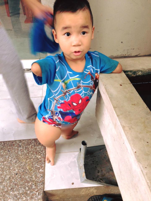 em bé khuyết tật em bé khuyết tật