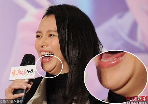 cằm ngấn mỡ cằm ngấn mỡ