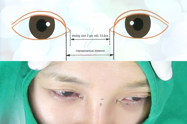 Cận cảnh phương pháp kích mắt to bằng phẫu thuật khóe & đuôi mắt 2