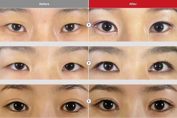 Cận cảnh phương pháp kích mắt to bằng phẫu thuật khóe & đuôi mắt 5