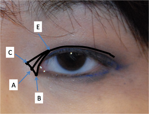 Cận cảnh phương pháp kích mắt to bằng phẫu thuật khóe & đuôi mắt 3