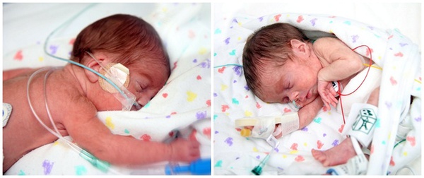 Người mẹ đầu tiên trên thế giới đẻ sinh đôi dù đang lọc thận 2