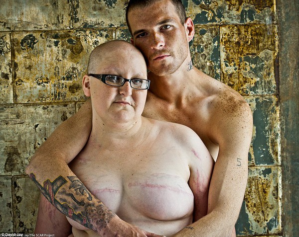 Những bức ảnh xúc động về bệnh nhân ung thư vú sau phẫu thuật 9