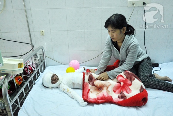 Bé gái 2 tuổi bị bỏng nặng khi ngã vào chậu nước tắm  