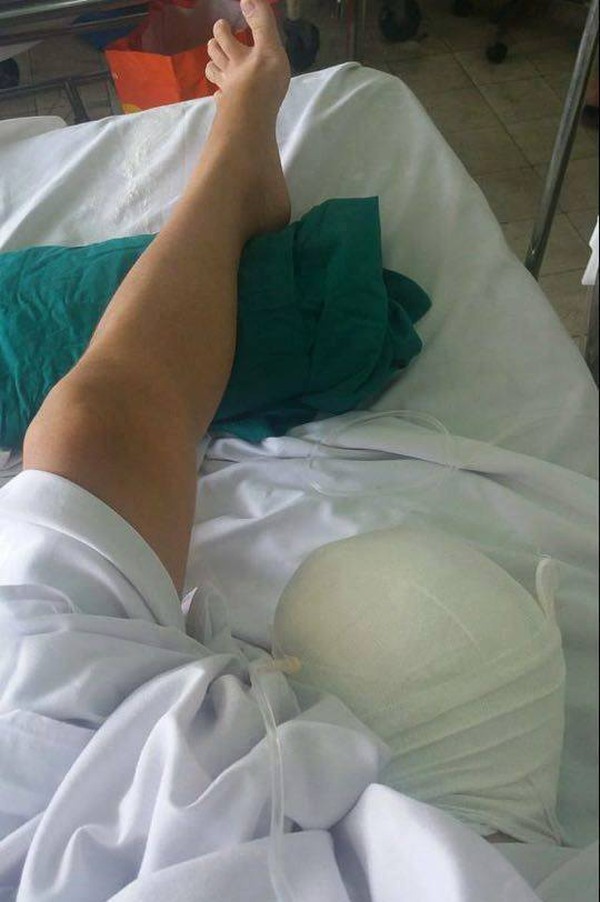 Đau xót thiếu nữ 15 tuổi xinh xắn phải cưa chân vì bị bác sĩ bó bột quá chặt 