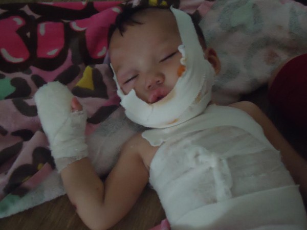 Ng&atilde; v&agrave;o bếp lửa, b&eacute; trai 10 th&aacute;ng tuổi nguy kịch