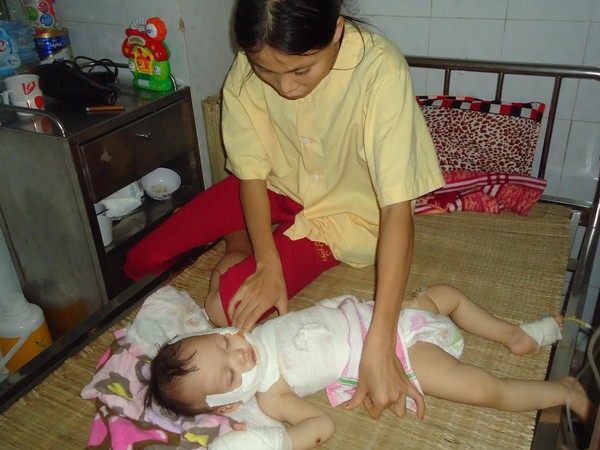 Ng&atilde; v&agrave;o bếp lửa, b&eacute; trai 10 th&aacute;ng tuổi nguy kịch