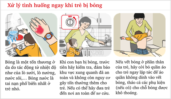 Xử trí khi con bị bỏng 1