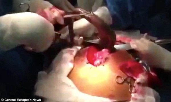 L&ocirc;i c&aacute; sống d&agrave;i hơn 1m khỏi bụng bệnh nh&acirc;n 1