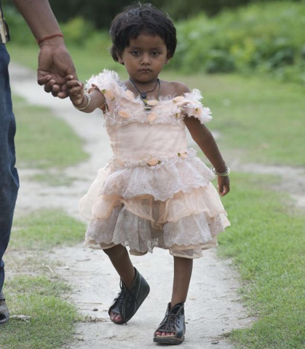 Những đứa trẻ sinh ra với bốn chân, bốn tay ở Ấn Độ 3
