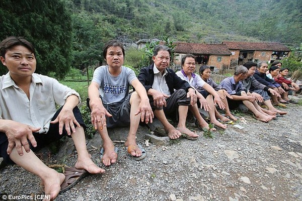 Bệnh lạ khiến người dân một ngôi làng bị xoắn xương tới biến dạng tay chân 3
