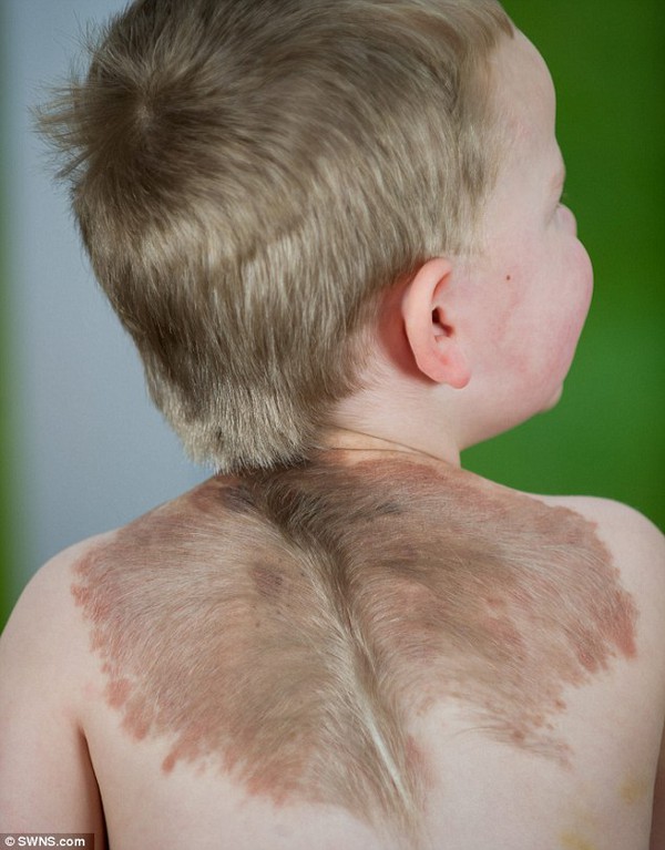 Bệnh lạ về da khiến bé trai mọc “đôi cánh” ở lưng 1