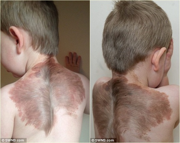 Bệnh lạ về da khiến bé trai mọc “đôi cánh” ở lưng 2