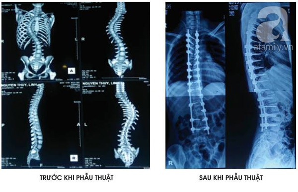 cột sống