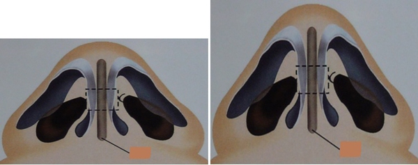  Nâng mũi silicone, sụn & tiêm - Đâu là phương pháp hoàn hảo nhất 6