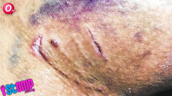 Một phụ nữ nhập viện vì bị trăn chui từ bồn cầu lên cắn vào đùi  2