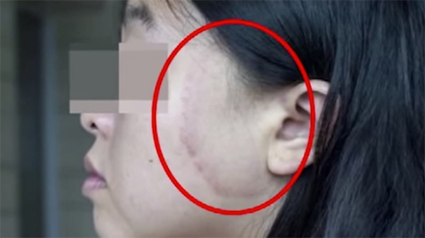 Cô gái tố bị iPhone lỗi làm bỏng, để lại sẹo vĩnh viễn trên mặt 1