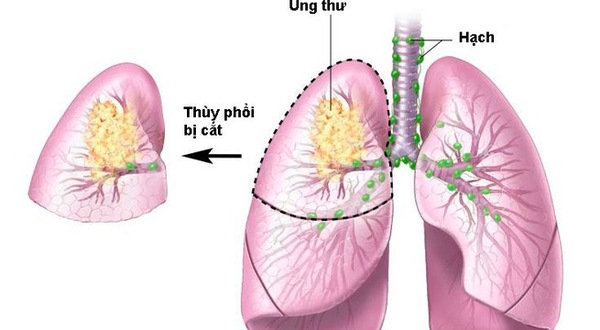 Ung thư phổi có thể nằm ẩn trong cơ thể hơn 20 năm 1
