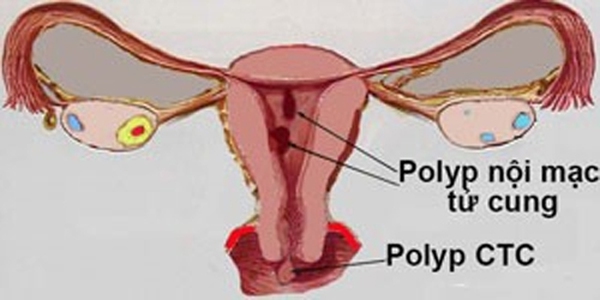 dấu hiệu polyp tử cung