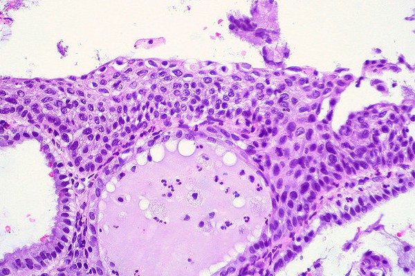 xét nghiệm pap smear