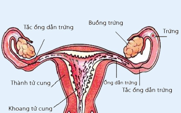 ung thư vòi trứng