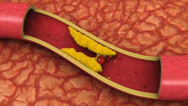 Cholesterol và nguy cơ bệnh tim