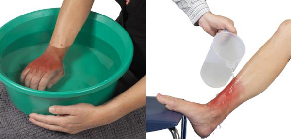 sơ cứu đúng cách khi bị bỏng sơ cứu đúng cách khi bị bỏng