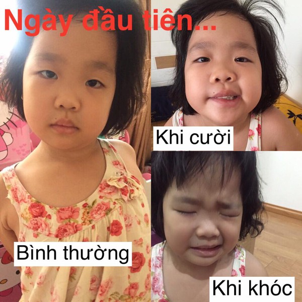 Viêm dây thần kinh ngoại biên số 7