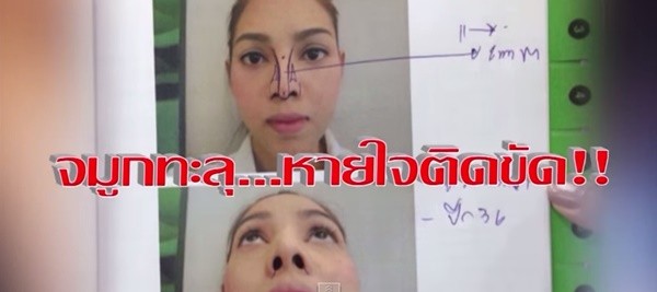 Cặp đôi Thái Lan bị biến dạng mũi do phẫu thuật thẩm mỹ hỏng 2