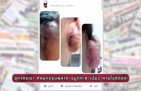 Cặp đôi Thái Lan bị biến dạng mũi do phẫu thuật thẩm mỹ hỏng 3
