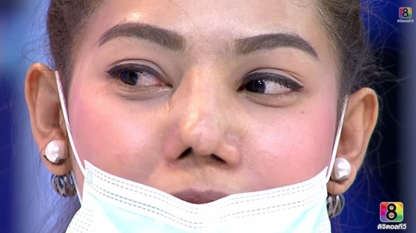Cặp đôi Thái Lan bị biến dạng mũi do phẫu thuật thẩm mỹ hỏng 5