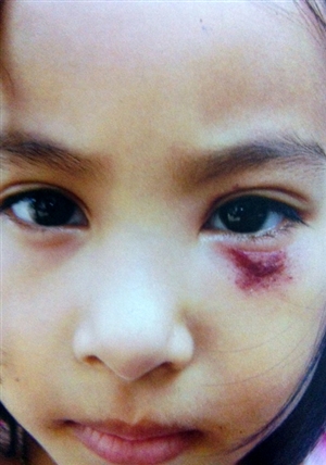 Phụ huynh tố cô giáo đánh bầm mắt bé mầm non 2