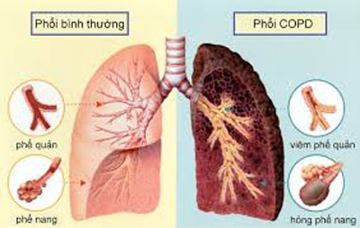 Tại sao bạn kh&oacute; thở ? 1
