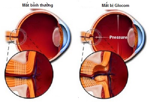 Mờ mắt nhanh, chớ coi thường  1