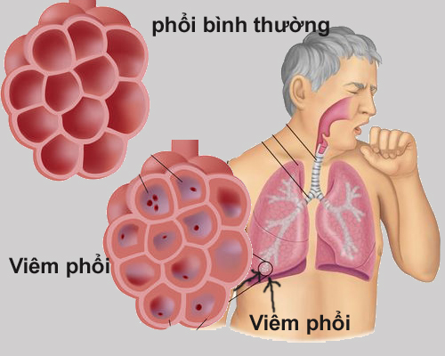 8 dấu hiệu của bệnh viêm phổi bạn không nên bỏ qua 1