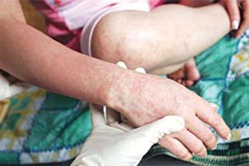 Gia tăng thêm nhiều bệnh nhân bị bệnh sởi - rubella 1