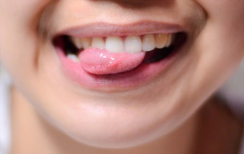 Đoán bệnh của bạn qua những biểu hiện ở lưỡi 2