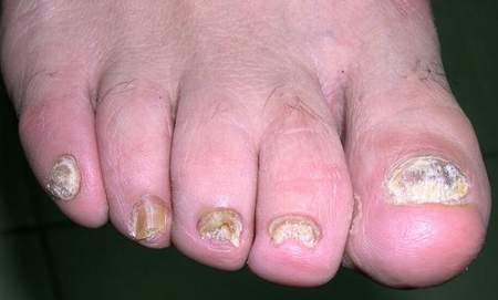 Một số bệnh hay gặp ở bàn chân 2