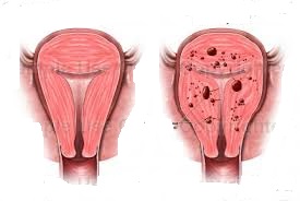 Phương pháp mới chữa lạc nội mạc tử cung 1