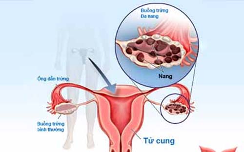 điều ít biết về hội chứng buồng trứng đa nang 2