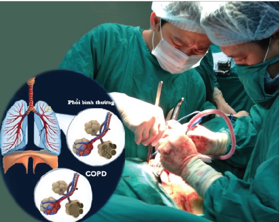 Ðột phá trong điều trị bệnh phổi tắc nghẽn mạn tính 1
