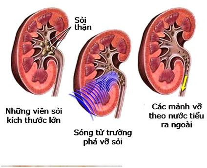 phòng ngừa bệnh thận 1