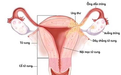 lạc nội mạc tử cung ở buồng trứng